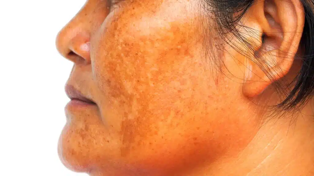 Memahami Melasma: Penyebab, Gejala, dan Pengobatan - Nucell Clinic